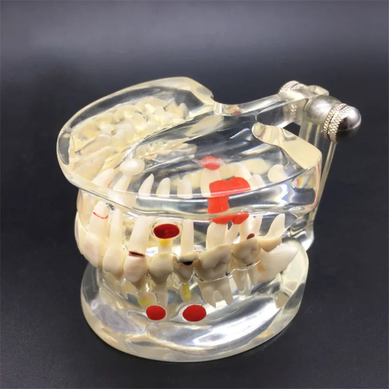 Стоматологическая полубоковая Съемная патологическая модель зубов для взрослых