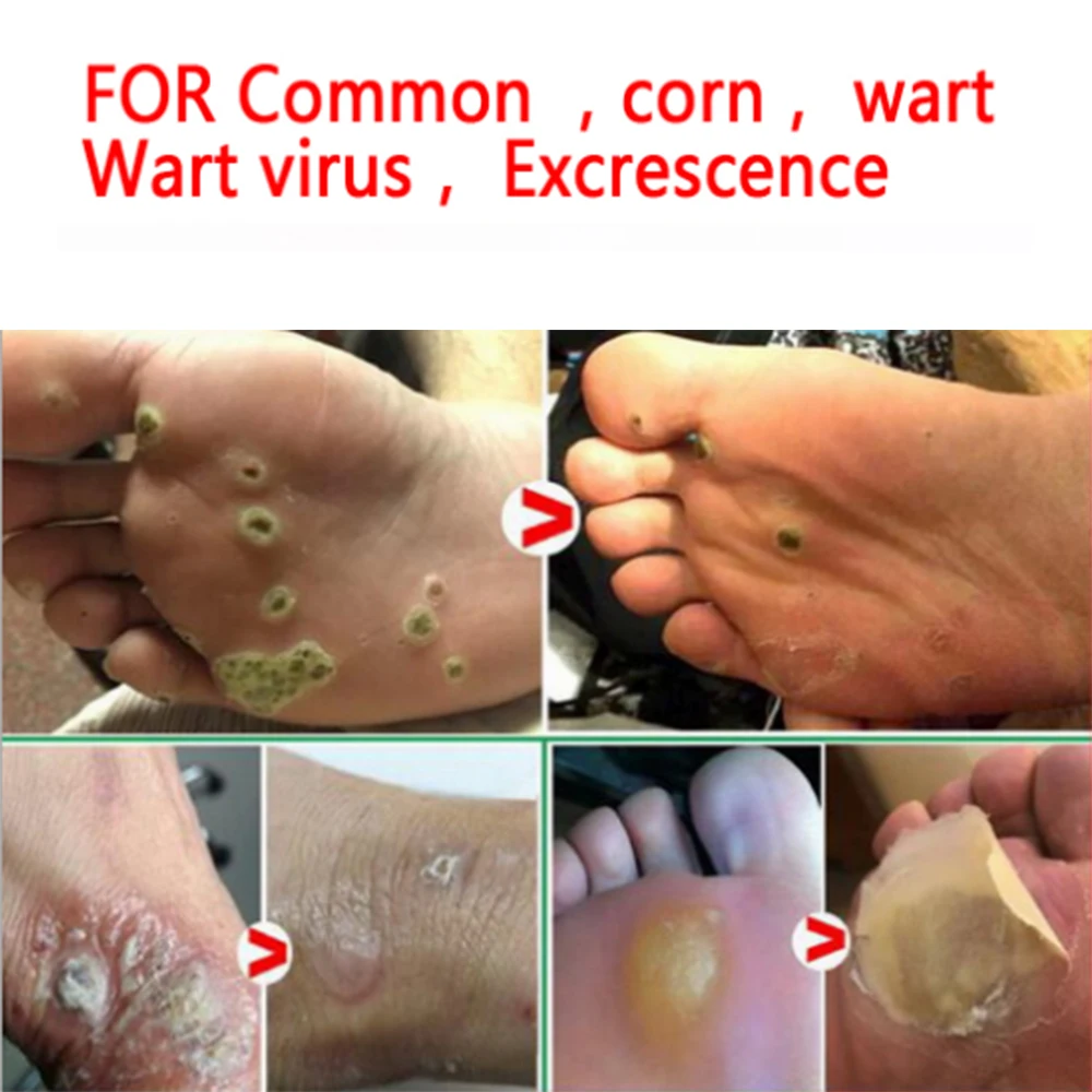 Китайский медицинский бородавок мазь для удаления мозолей ног тег кожи пластырь