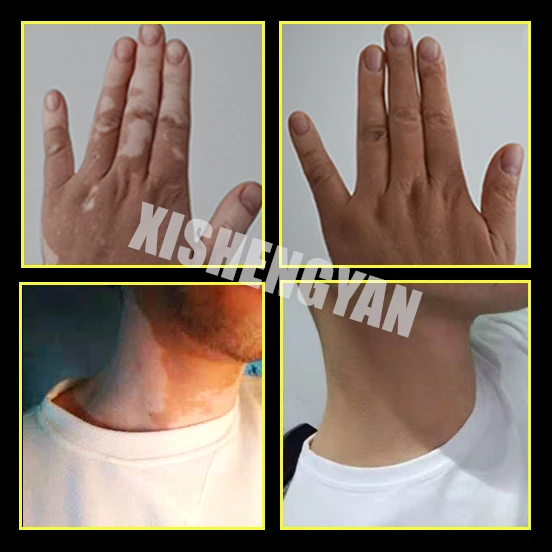 Ручка для макияжа Vitiligo Leukoderma водостойкий консилер растительная эссенция Жидкая