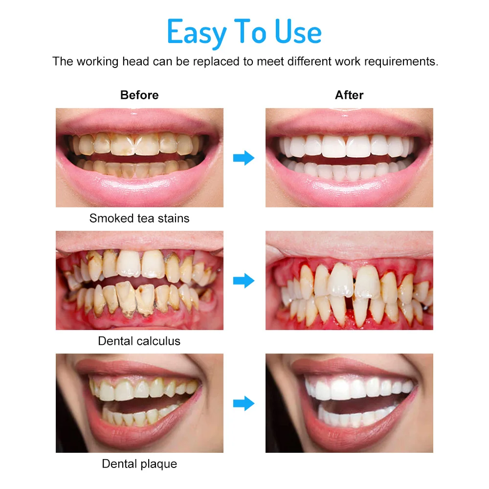 

Portable Ultrasonic Calculus Remover Dental Scaling Electric Scaler Sonic Smoke Stains Tartar Plaque Teeth Oral Irrigator