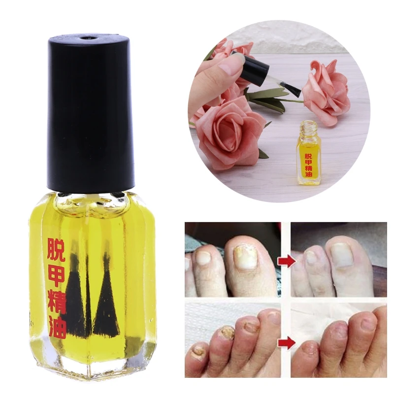 

Painless Nail Removal Nail Treatment Repair Nails Care Fungus Essential Oil 5ML