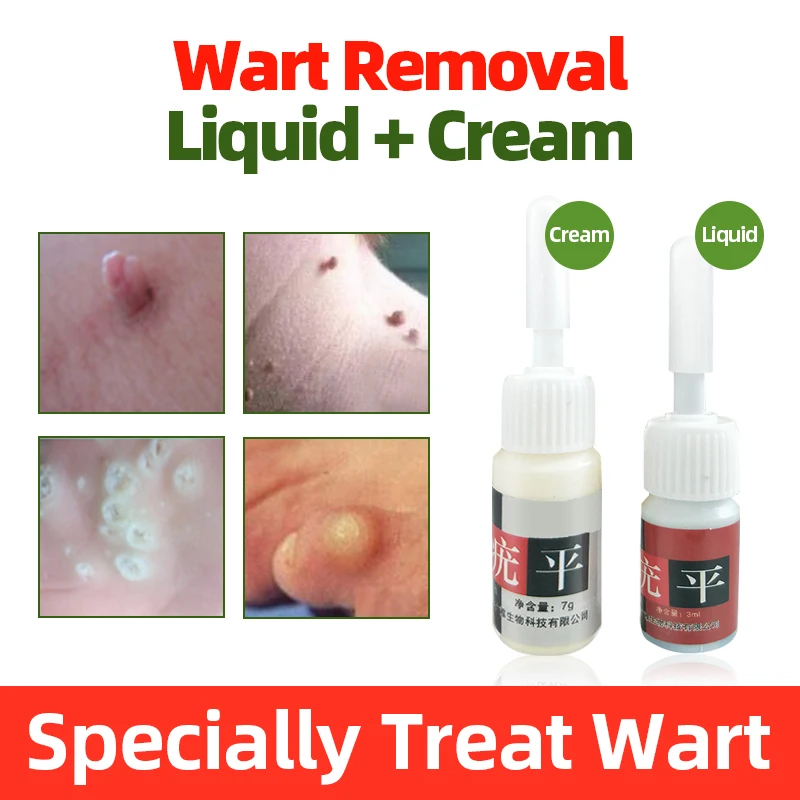 Остроконечной кондиломы мясо шип Антибактериальный крем для ног &quotКукуруза&quot