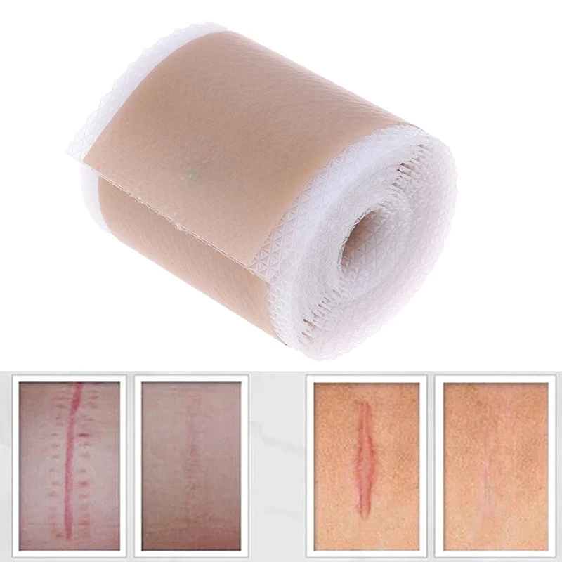 

Efficient Beauty Scar Removal Silicone Gel Self-Adhesive Silicone Gel Tape Patch for Acne Burn Scar Reduce