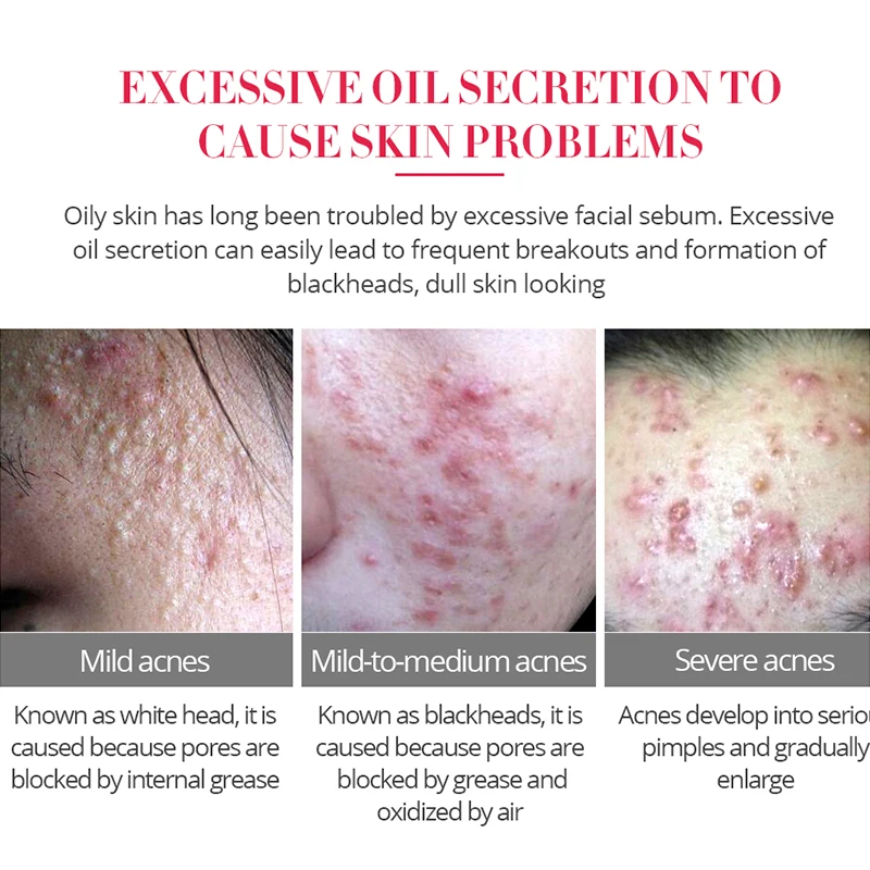 30 г лечение акне очищающий крем для лица против сокращение пор удаление жирной