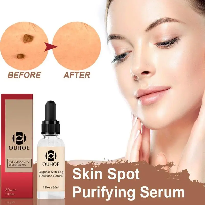 

30ml Wart Mole Remover Organic Skin Tags Spot Solution Serum Freckle Fast Removing Essence Painless Face Skin Care Serum