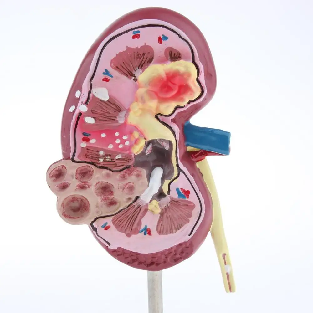 Медицинский орган почек анатомическая модель лезии анатомии человека учебные