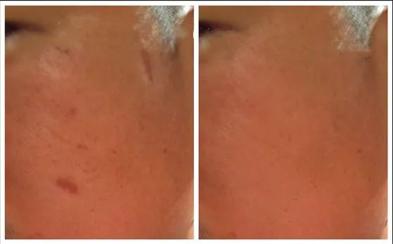 

Eliminate scar repair hyperplasia scar cream + scar liquid
