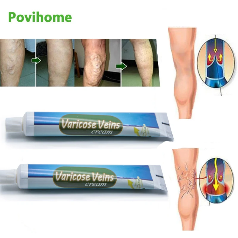 

1 шт., травяной крем для лечения варикозного расширения вен, 20 г