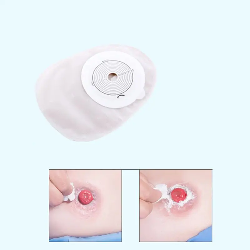 10 шт. взрослых одноразовые Colostomy сумки поставкы Ostomy может дренажный мешок для