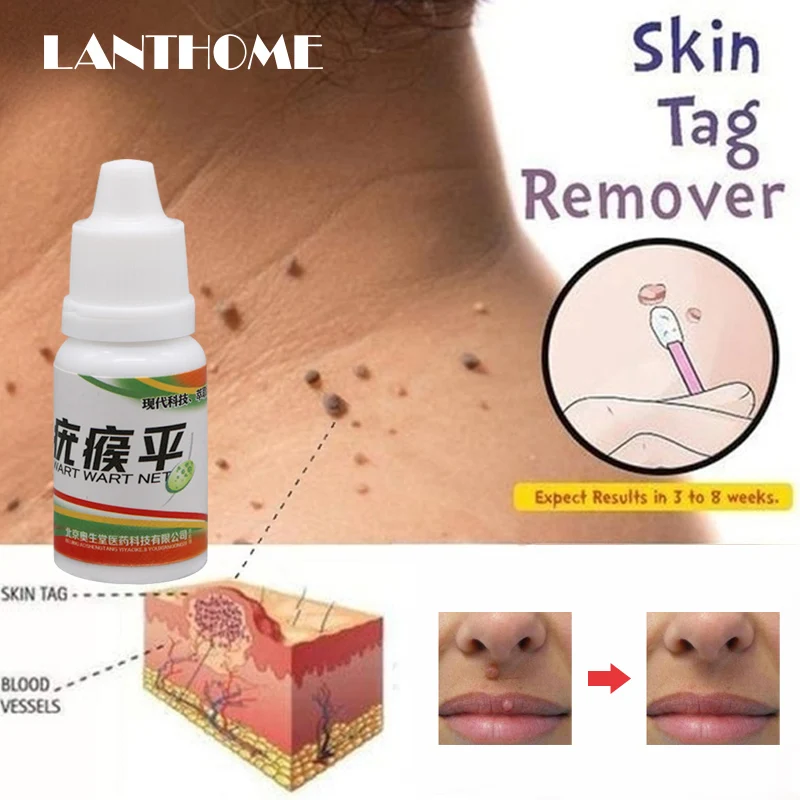 Black Dots Mole Wart Skin Tag Remover 12 Hours Tu Kill Liquid Medical Foot Corn Removal Care Solution |