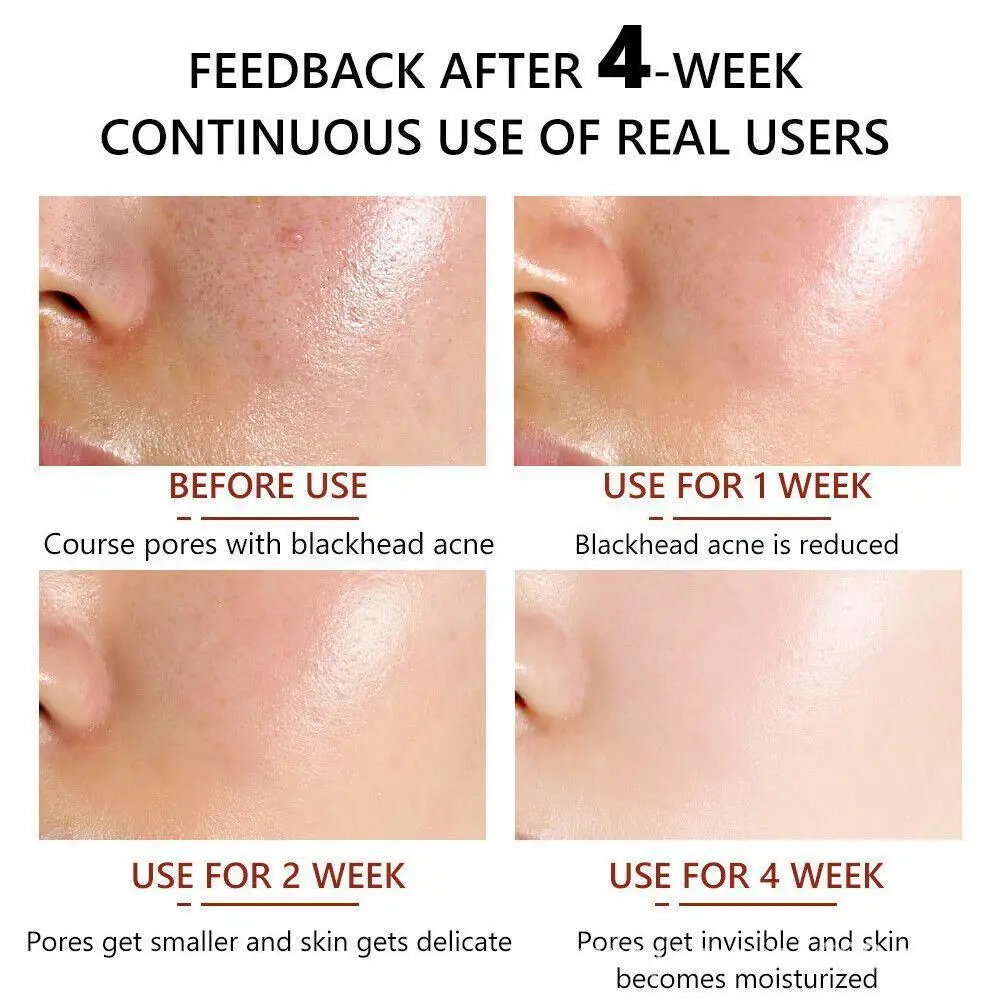 

Salicylic Acid Face Serum Hyaluronic Acid Shrink Pores Control Liquid Essence Lighten Anti-Wrinkle Skin Oil Moisturizing Ca G0Y5