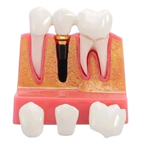 1pc dental implant teeth model study teach 4 times model with removable teeth