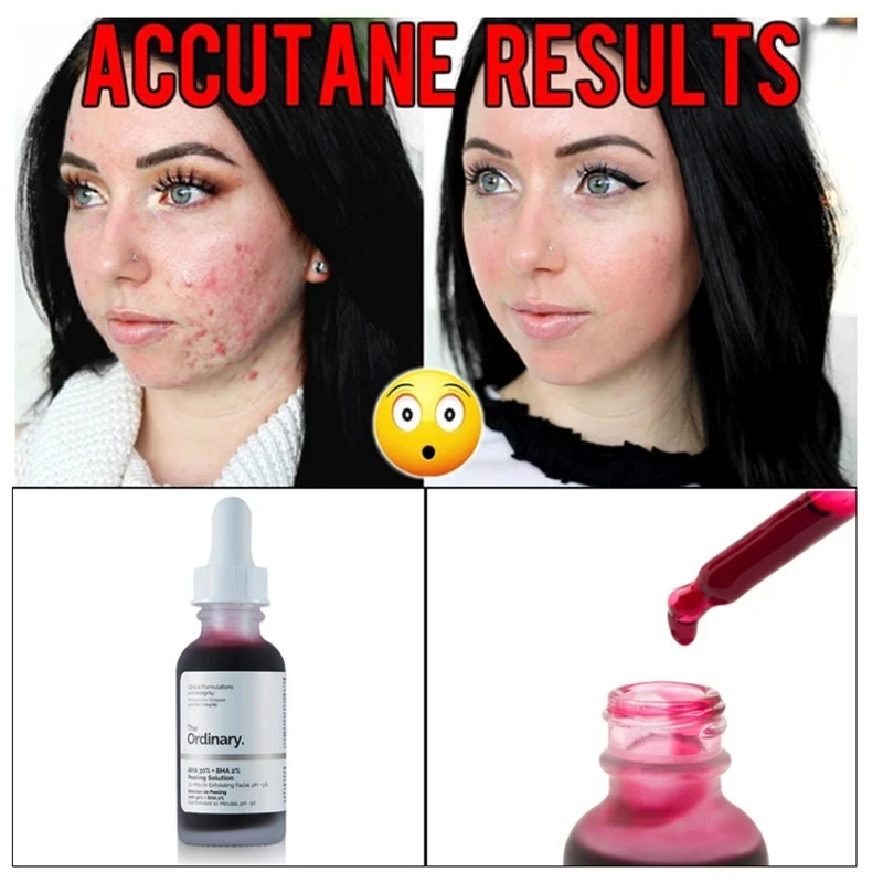 Niacinamide 10% Отшелушивающий раствор AHA 30% + BHA 2% Гиалуроновая кислота отбеливающий