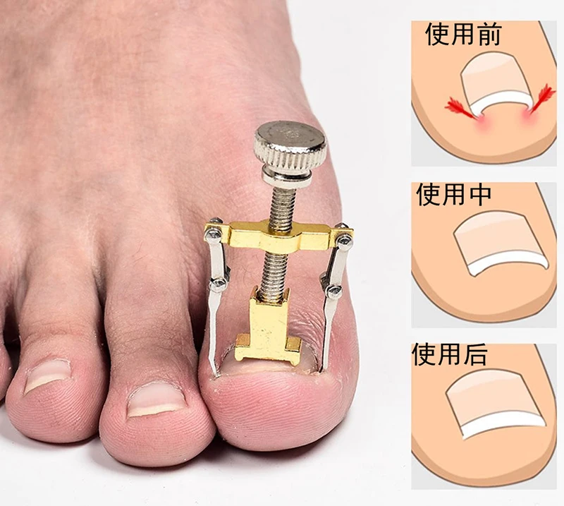 Ingrown Toenails Pedicure Foot Nail Care Tools File for Feet Orthotic Acronyx Bunion Corrector Toes Hot Sale | Красота и здоровье