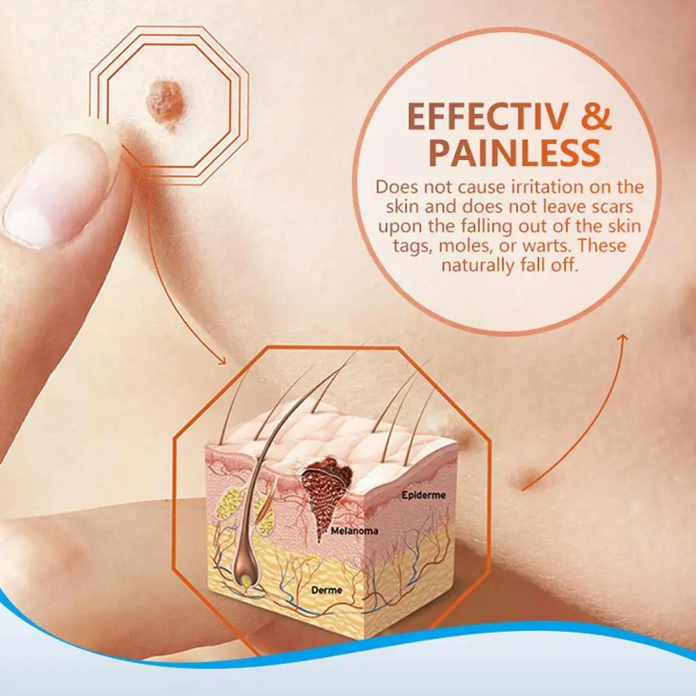 

Wart Cream Skin Tag Remover Antibacterial Cream Micro Extract Wart Ointment Face Body Herbal Mole Care Ointmen O9F8