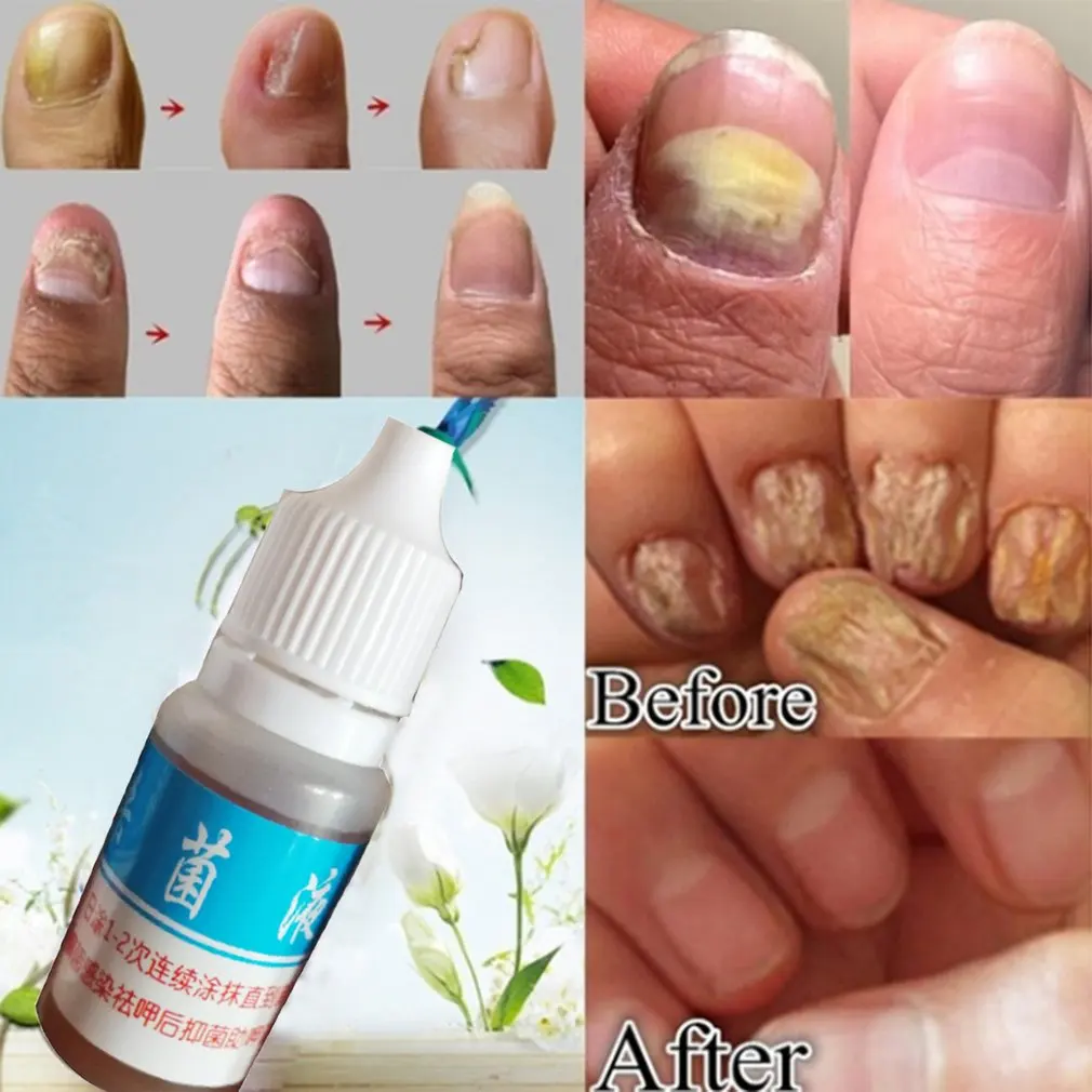 10 мл натуральный Уход за ногтями уход здоровой кожей для ухода лечение жидкое