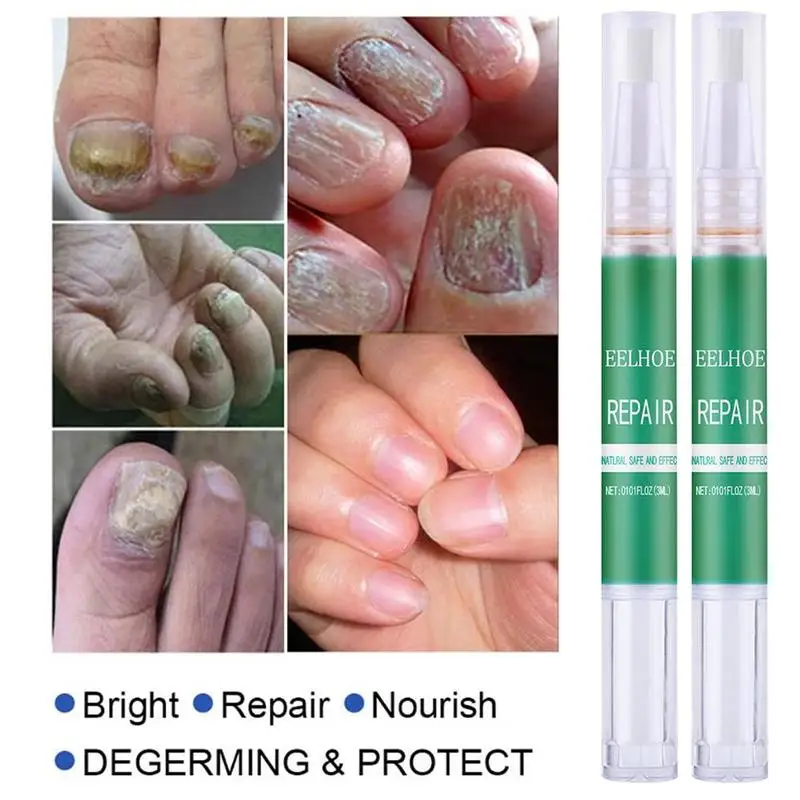 

Nail Anti-Fungal Treatment Set Nail Treatment Pen Onychomycosis Fungus Care Repair Paronychia Kit Serum Fungus Anti J4O7