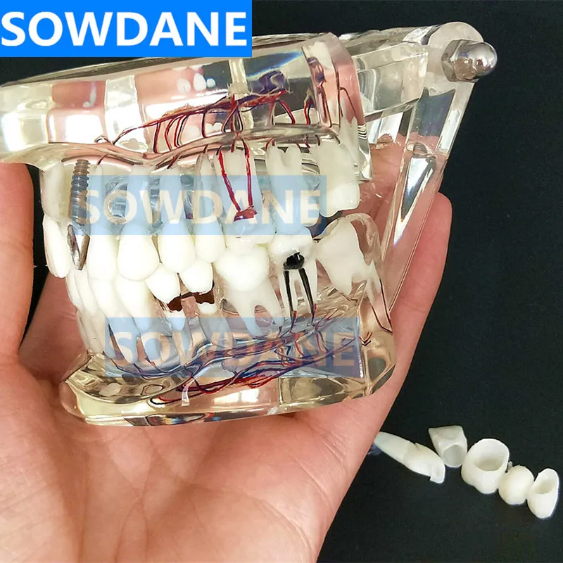 Модель зубного имплантата с мостиком для восстановления зубов стоматолог