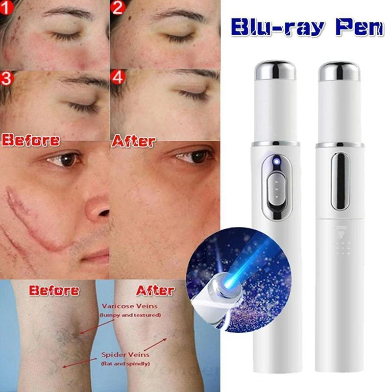 

Blue Light Therapy Pen For Varicose Veins Therapy Wrinkle Acne Laser Pen Pen For Varicose Veins Acne Laser Pen Massage Relax