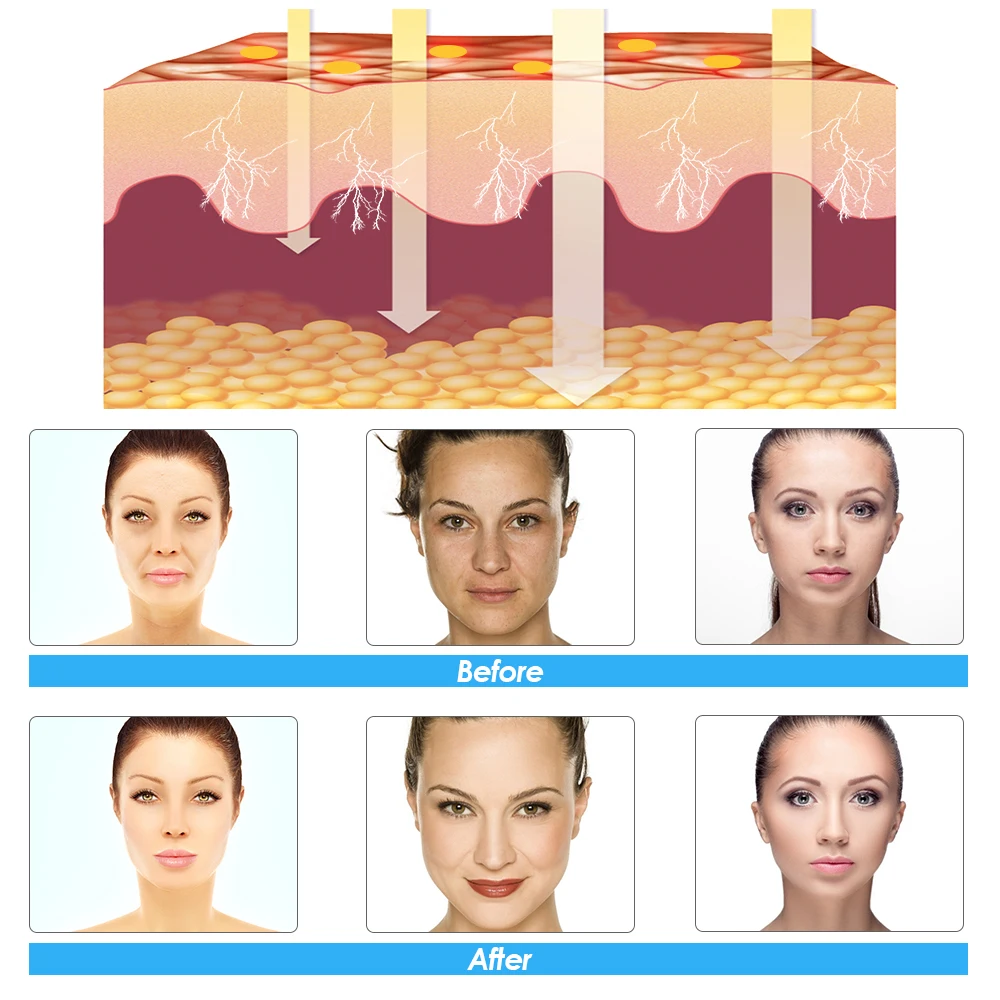 Импортер масок устройство для стягивания кожи аппарат подтяжки омоложения EMS