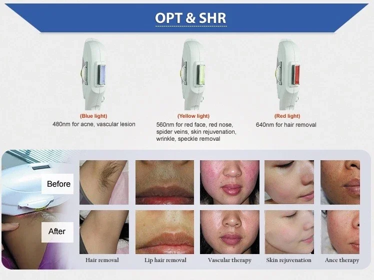 Многофункциональная машина красоты 4 в 1 elight ipl opt shr rf nd Yag Лазерное удаление татуировки/машина для удаления волос