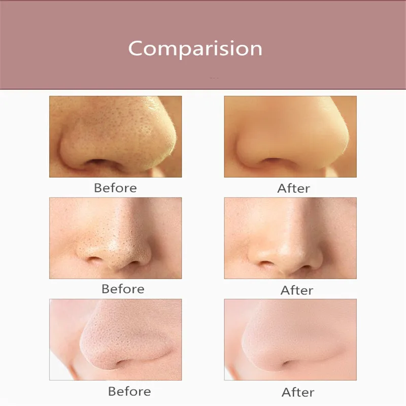 

Electric Facial Pore Cleaner Exfoliator Face Blackhead Remover Acne Vacuum Deep Cleansing Suction Machin Nano Sprayer Steamer