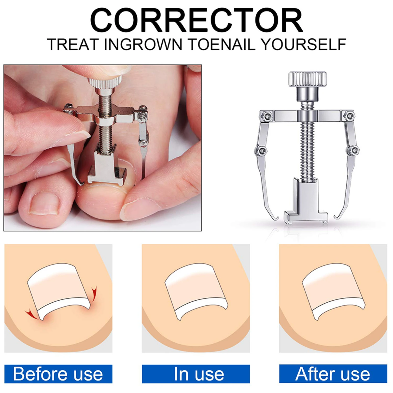 Набор инструментов для удаления вросших ногтей профессиональные инструменты