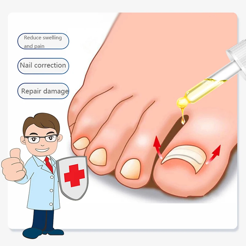 1/2 шт. сыворотка для лечения грибка ногтей | Красота и здоровье