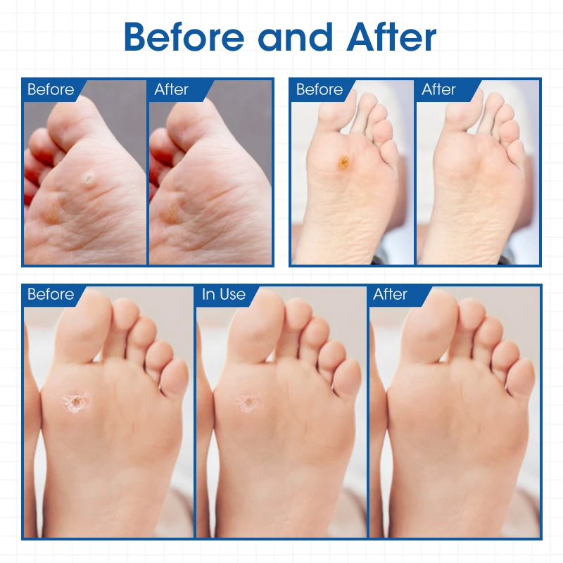24 шт. медицинские пластыри для удаления мозолей на ногах | Красота и здоровье