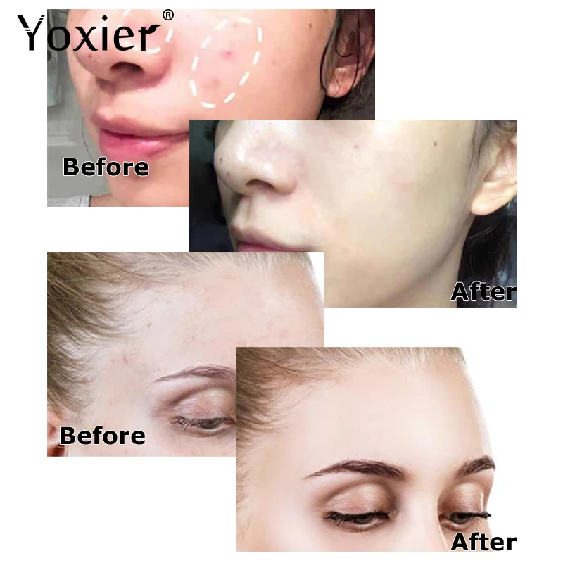 Пластырь для быстрого удаления прыщей экстракт чайного дерева невидимые