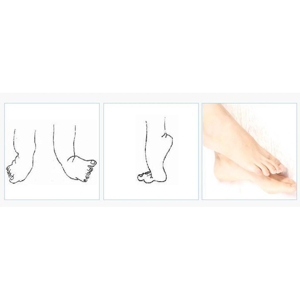 

Foot Drop Orthosis Ankle Foot Drop Postural Correction Brace Orthosis Splint
