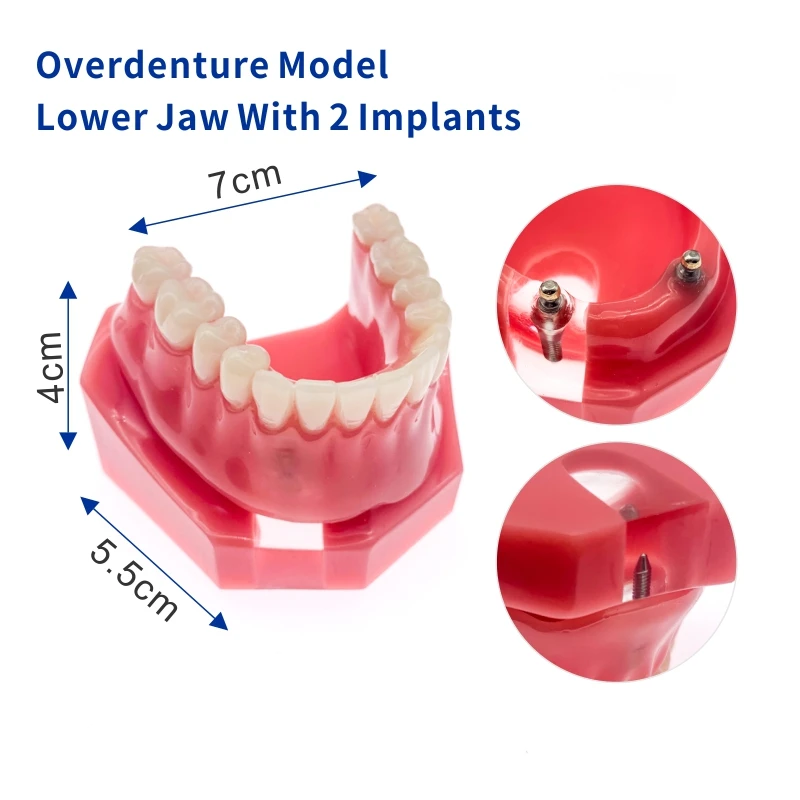 Стоматологическая уступает имплантат Overdenture 6007 модель зубов 2 импланты с