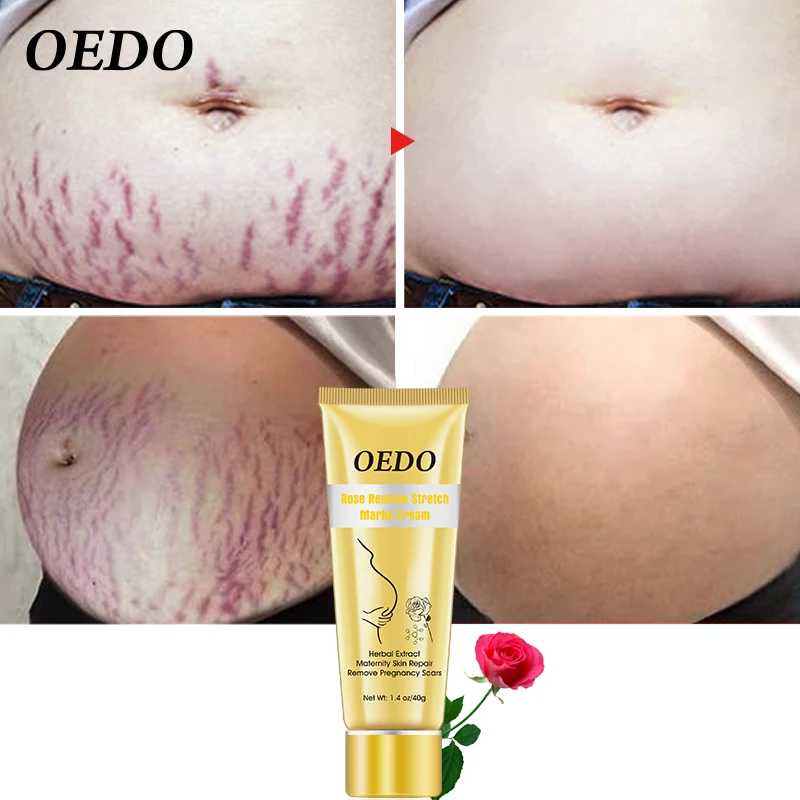 Крем для устранения растяжек и ожирения после родов антивозрастной укрепляющий