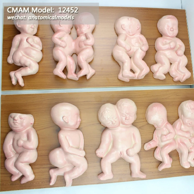 CMAM/12452 патологическая модель плода мочеполового и медицинского обучения