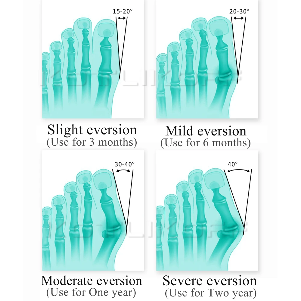 2Pcs Silicone Hallux Valgus Toe Separator Silicone Insoles Toe Overlapping Pain Relieve Spreader Foot Protector Inserts Orthosis