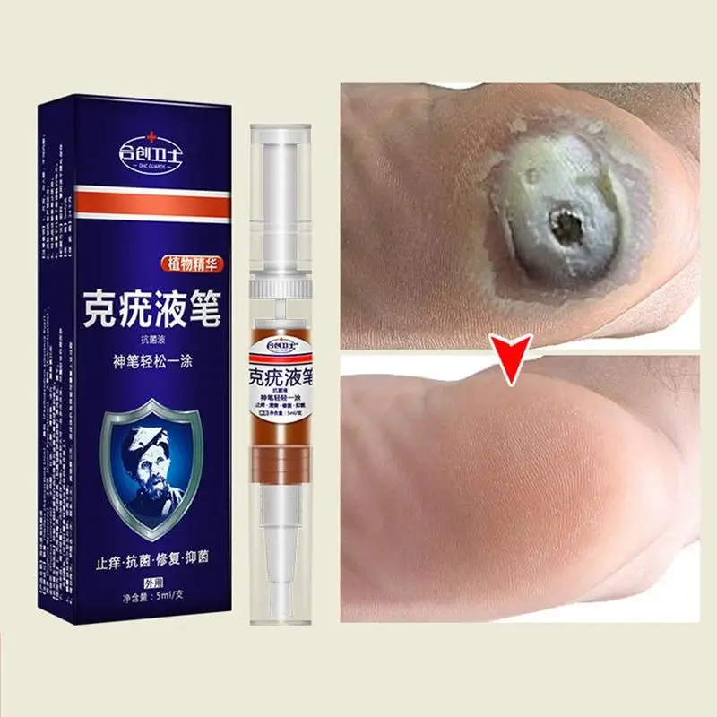 Средство для удаления мозолей на ногах сверхпрочное средство бородавок 12 часов 5