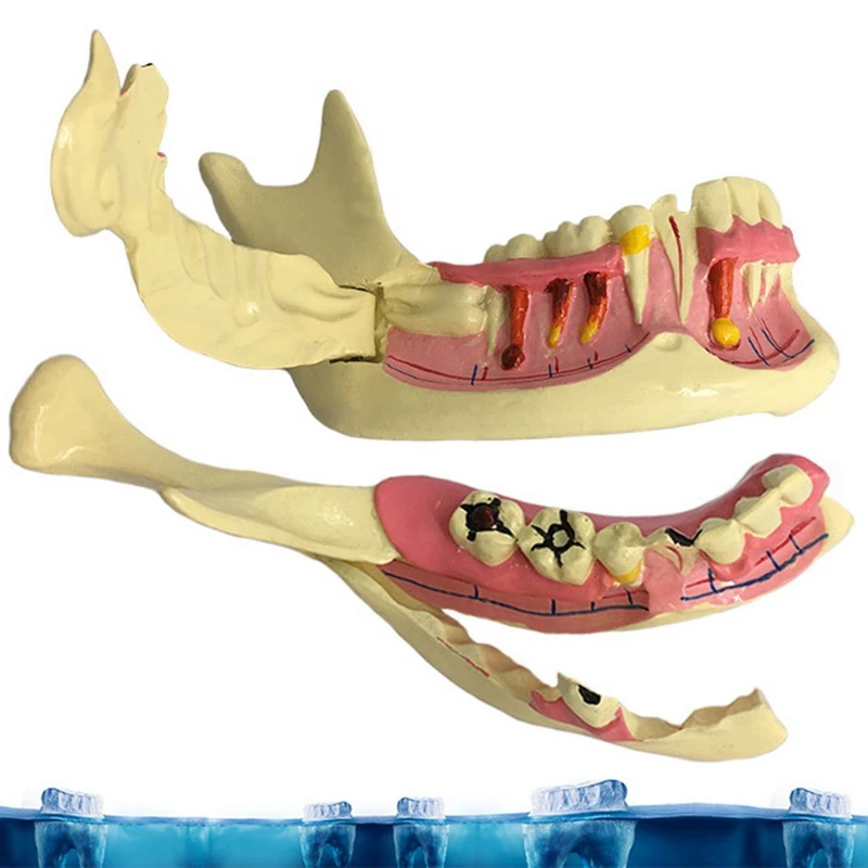 

Endodontic Treatment Model Anatomy of Gums Study Teach Teeth Model Adult Pathology Model