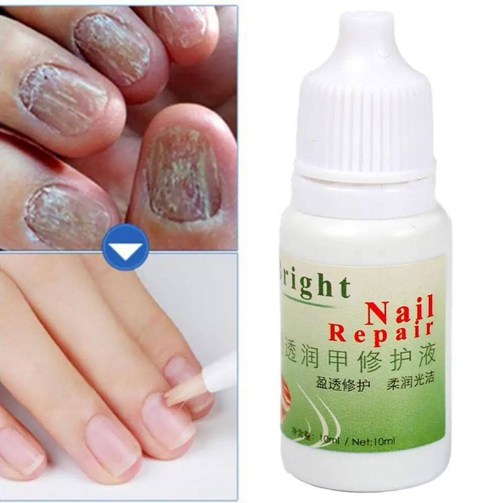 

1Pc10ML Schimmel Nagel Behandeling Pen Onychomycose Infectie Kruiden Anti Schimmel Nagel Paronychia Geneeskrachtige Zorg Ch Y4M1