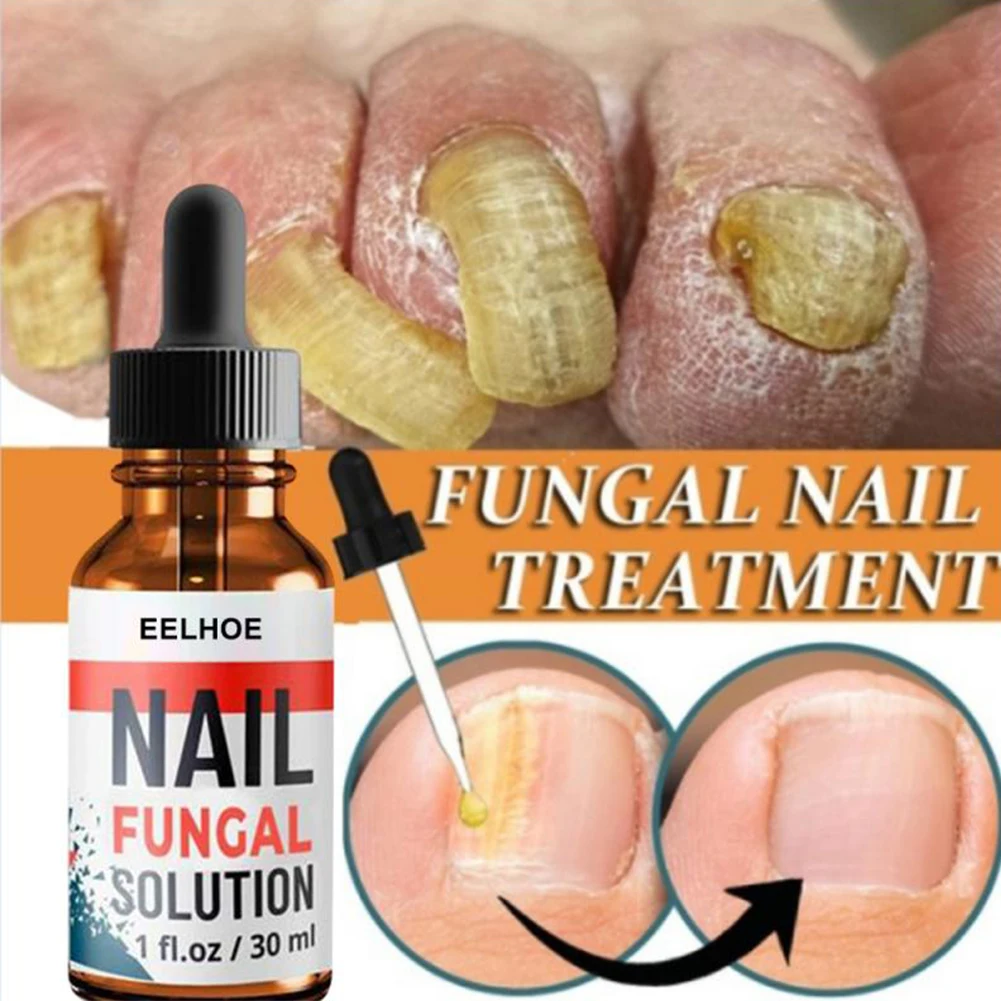 

10/20/30ml Oenail Fungus Treatment Antifungal Nail Solution Ringworm Clear Healthy Toenail Growth Toe Nail Care