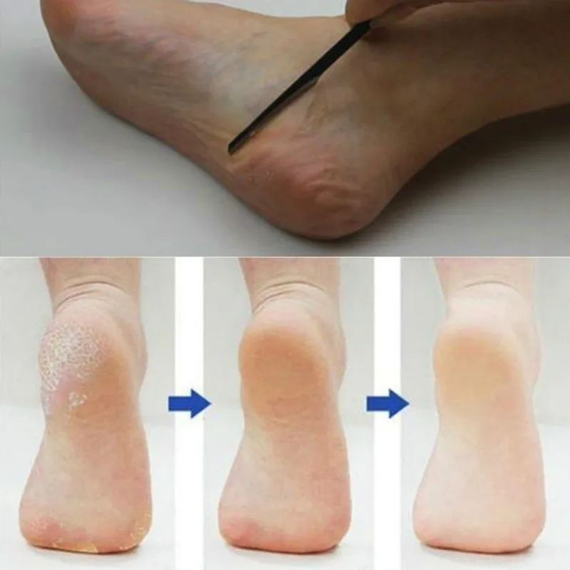 Педикюрный и маникюрный прибор для удаления омертвевшей кожи отшелушивающий