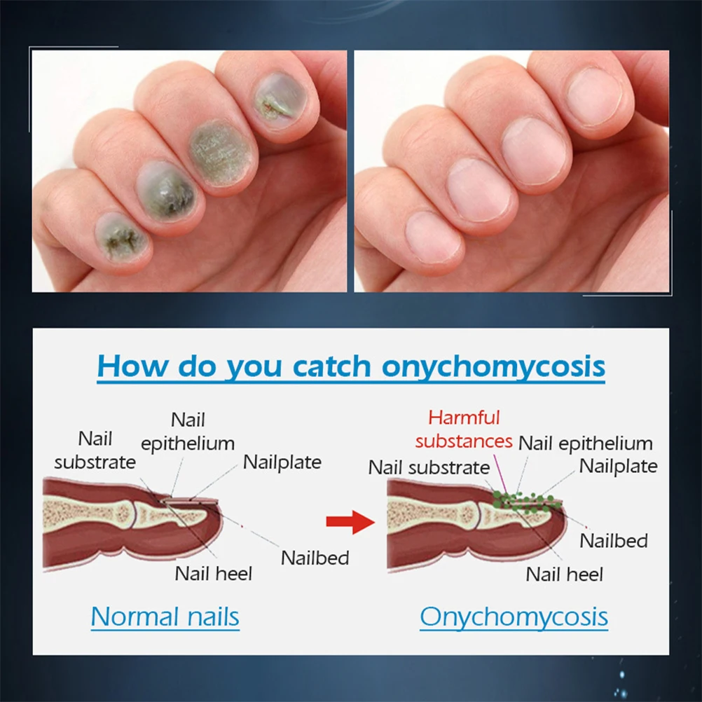 20g Nail Fungus Treatment Cream Onychomycosis Paronychia Anti Fungal Infection Kills Bacteria And | Красота и здоровье