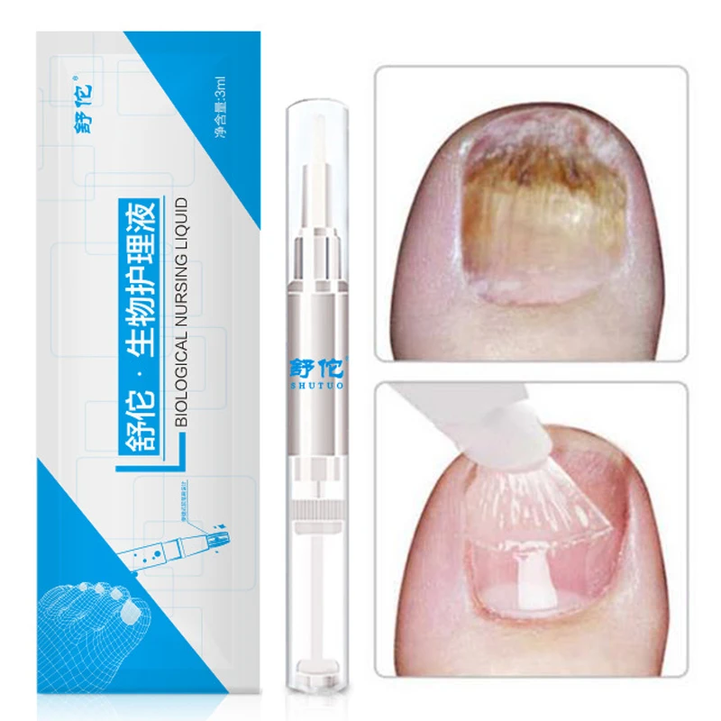 

3ML Fungal Nail Treatment Pen Onychomycosis Paronychia Anti Fungal Nail Liquid