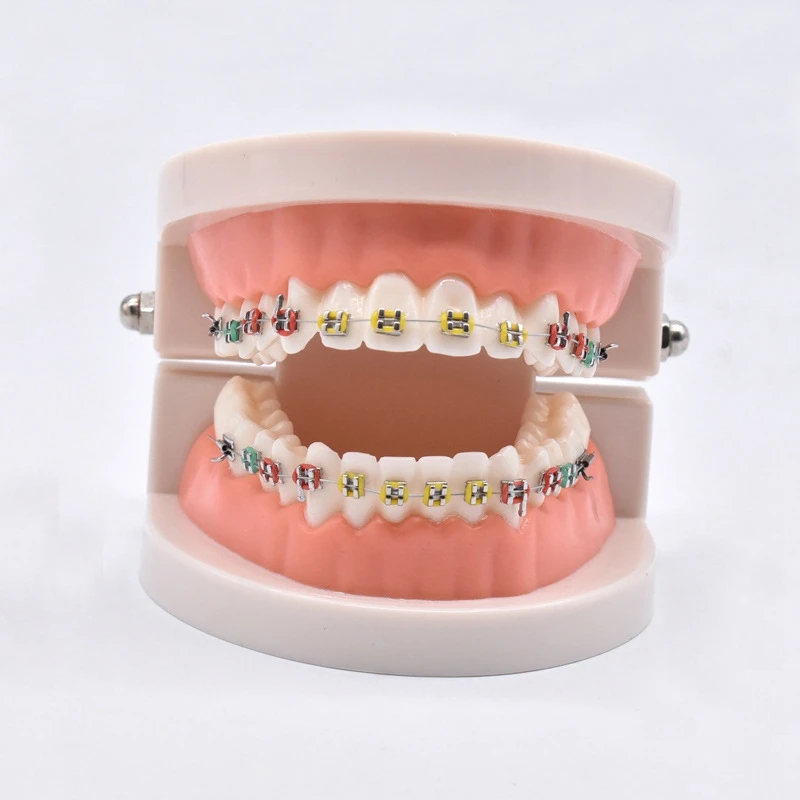 Ортодонтическая лечебная модель с ортодонтическим металлическим керамическим