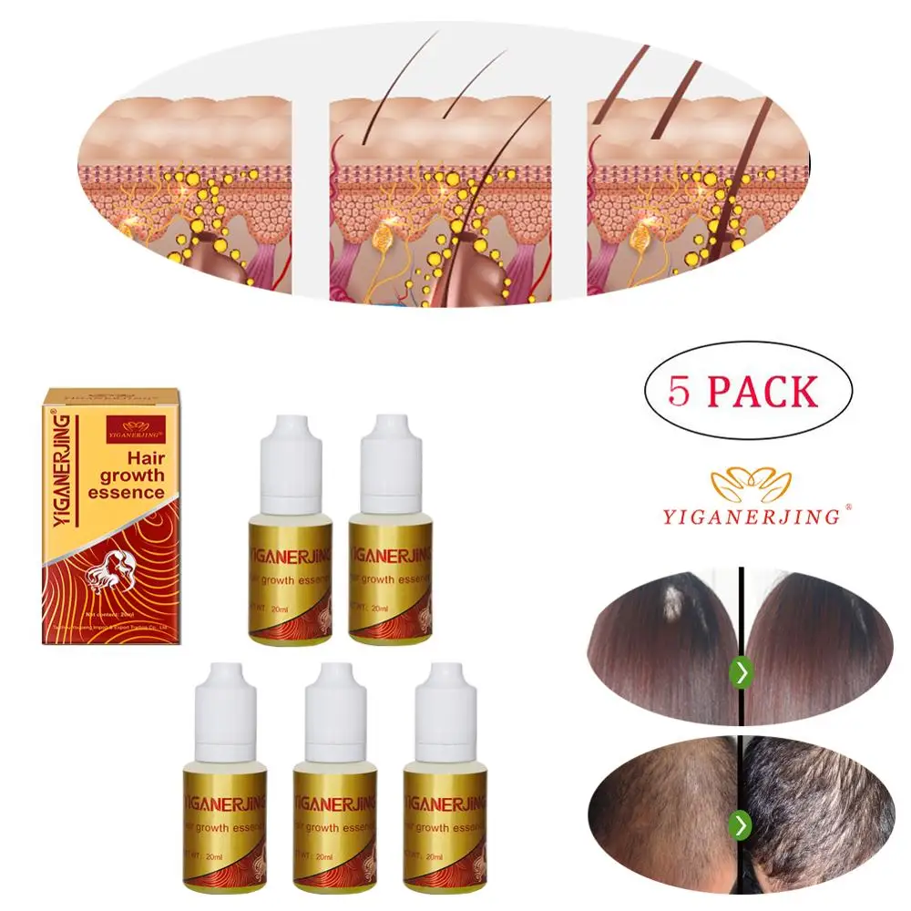 5PCS Экстракт имбиря, густые волосы, быстрая Защита от солнца, восстановление эссенции роста, YIGANERJING уход, масло, жидкая сыворотка для выпадения волос(20 мл - Цвет: 5PCS