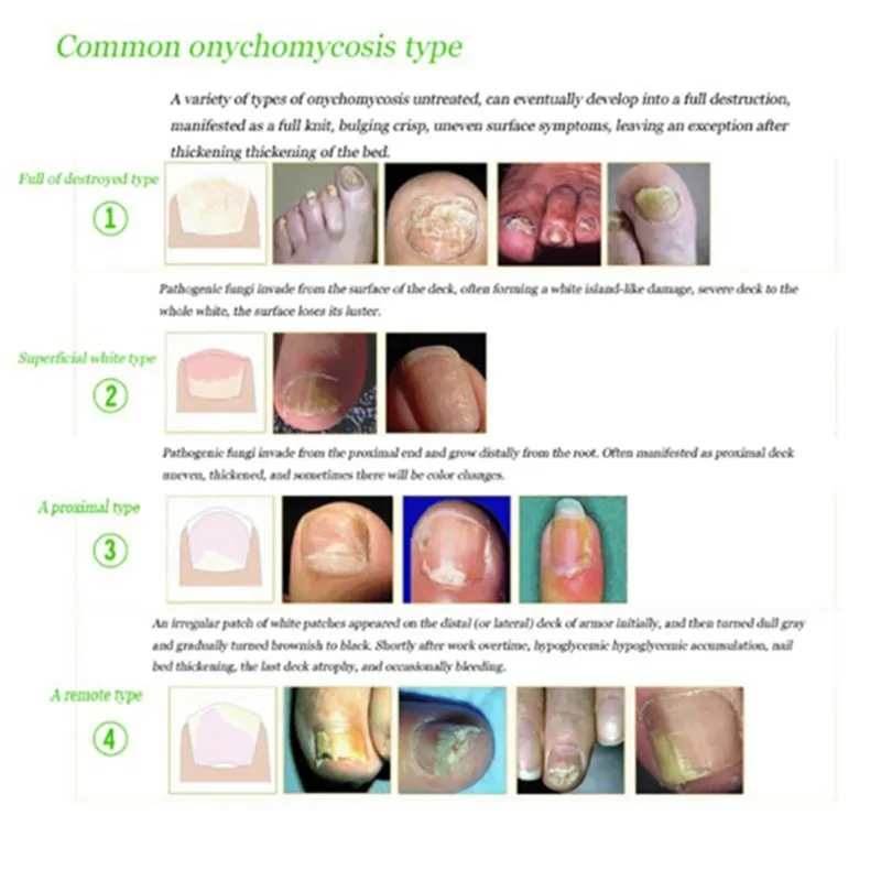 10 мл жидкое антибактериальное очищающее средство для ухода за кожей ногтями