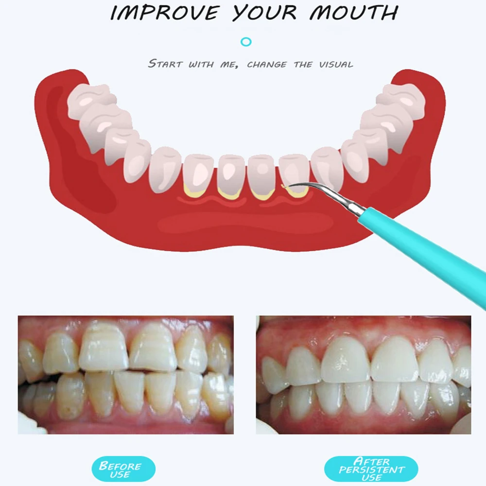 Электрический ультразвуковой прибор для чистки зубов|Электрические зубные