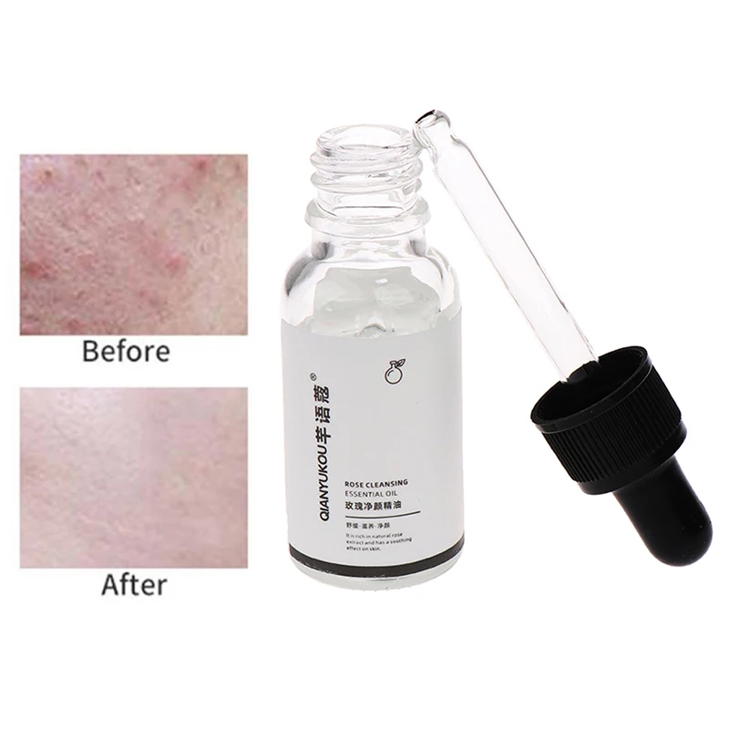 

Безболезненное средство для удаления родинок и кожи, крем для удаления черных точек на лице, бородавок, веснушек, акне, масляный пластырь