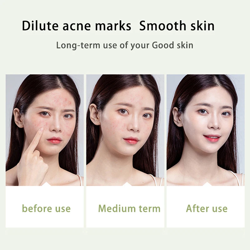 

20g Acne Treatment Blackhead Remova Anti Acne Cream Oil Control Shrink Pores