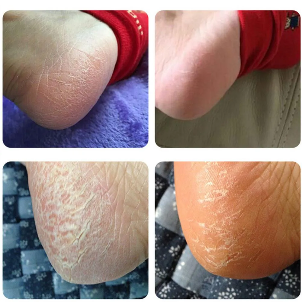 Highly Concentrated Moisturizing Agent Cracking Cream For Rough Dry And Cracked Heel Skin Anti-heel | Красота и здоровье