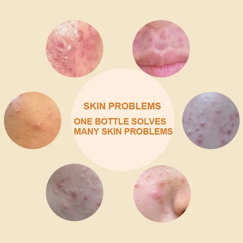 

BREYLEE Acne Treatment Face Serum Mask Anti Acne Pimple Scar Remover Moisturizing Whitening Skin Care Facial Essence Cream 17ml